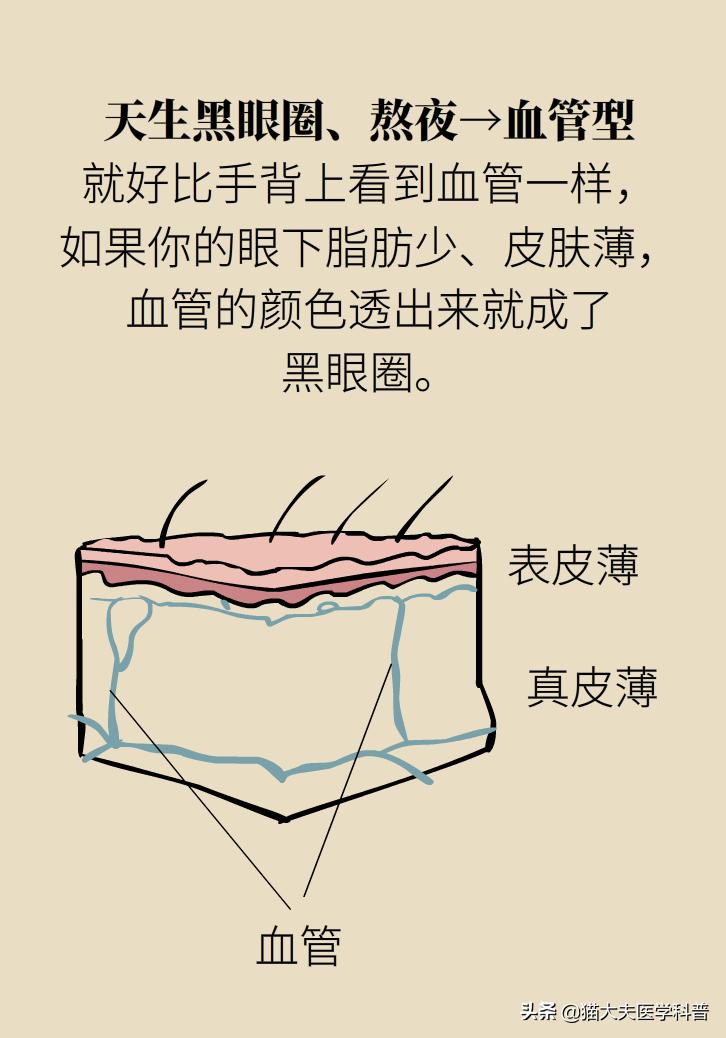 医生黑眼圈,手术消除黑眼圈靠谱吗