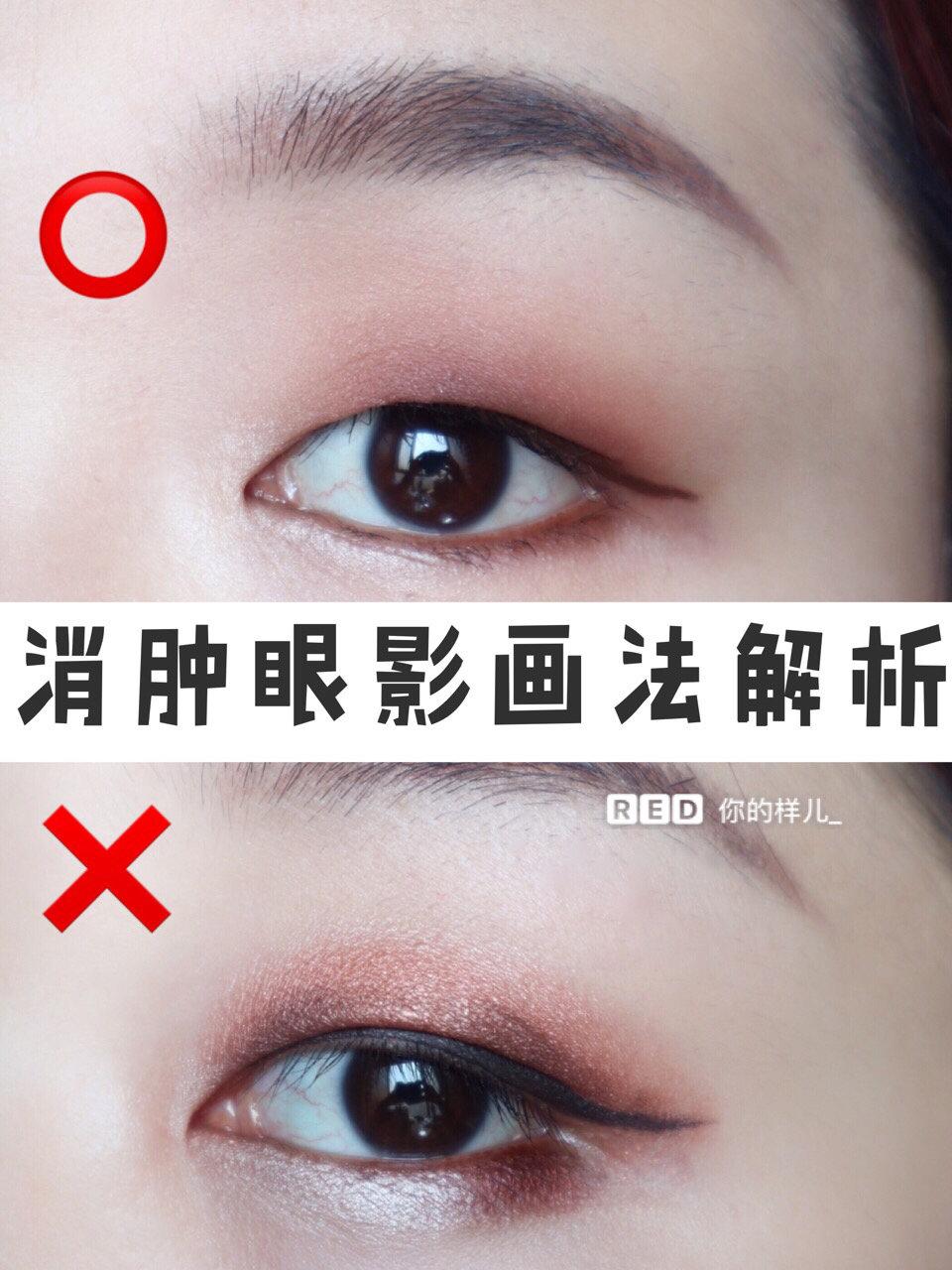 肿眼泡内双怎样贴出宽大双眼皮,肿眼泡内双眼皮怎么整形