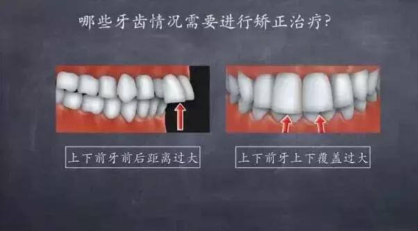 牙齿矫正拔牙后会反弹成原样么,牙齿矫正后反弹可以重新矫正吗