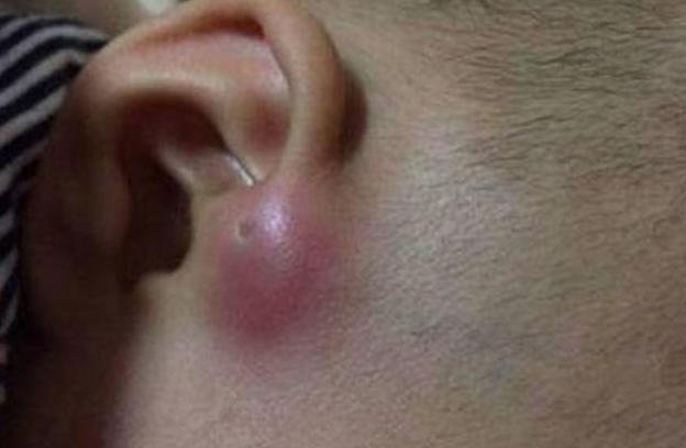 4岁宝宝耳朵里长个疙瘩,4岁男孩耳朵上长了个小孔