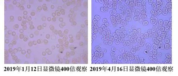 血液粘稠的病因及治疗,健康血液粘稠别小看但也别乱治
