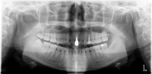 牙齿做根管治疗后补牙多少钱一颗,为什么要做根管治疗不能直接补牙