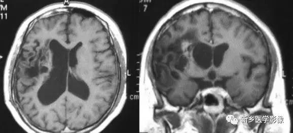 脑室为什么会扩张,脑室为什么会变小