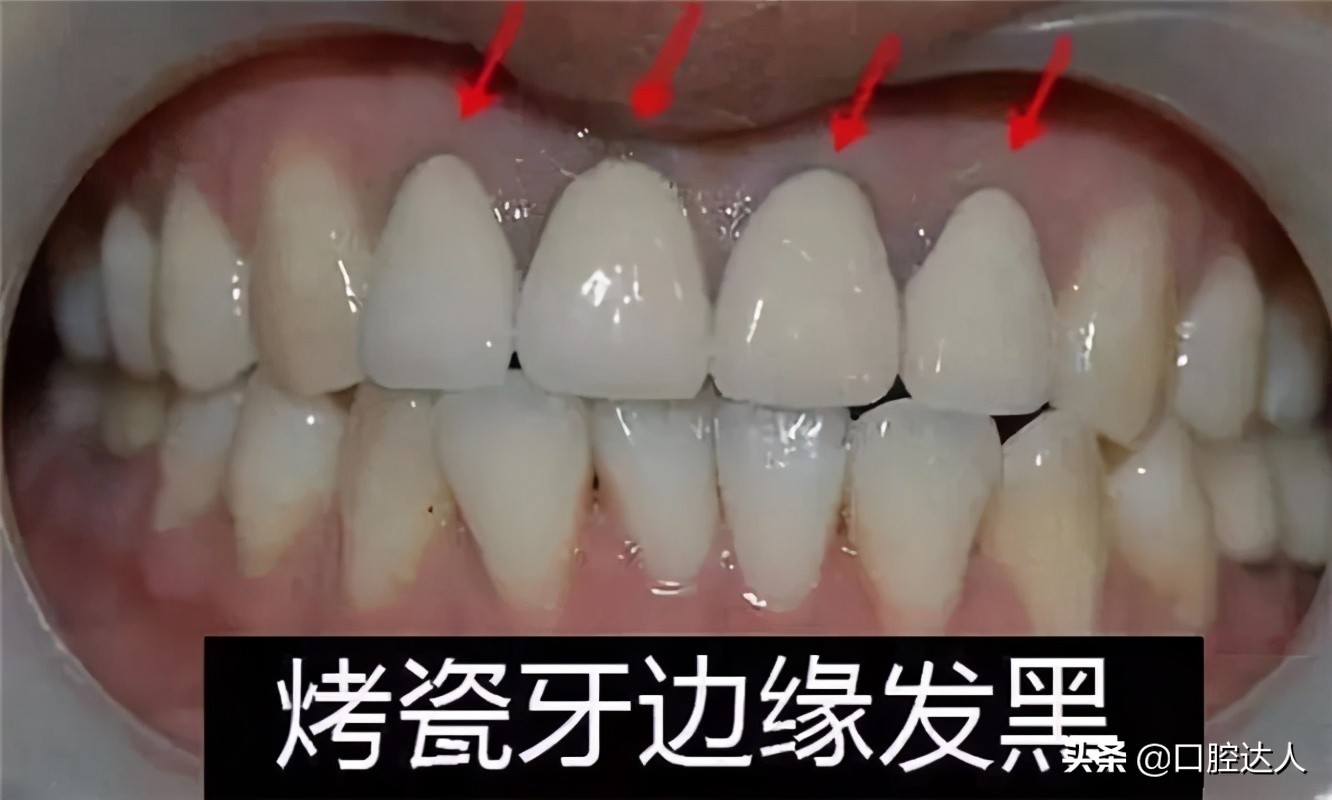 烤瓷牙十几年了有必要更换吗,烤瓷牙做出来变成龅牙了