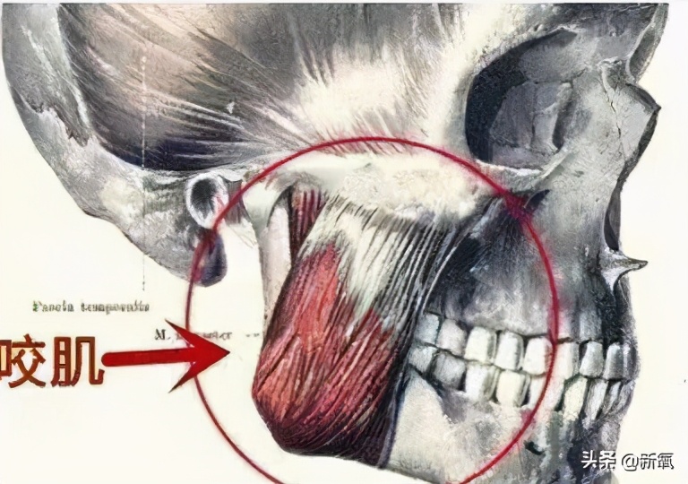戴牙套真的会出现牙套脸,戴牙套期间牙齿变龅了