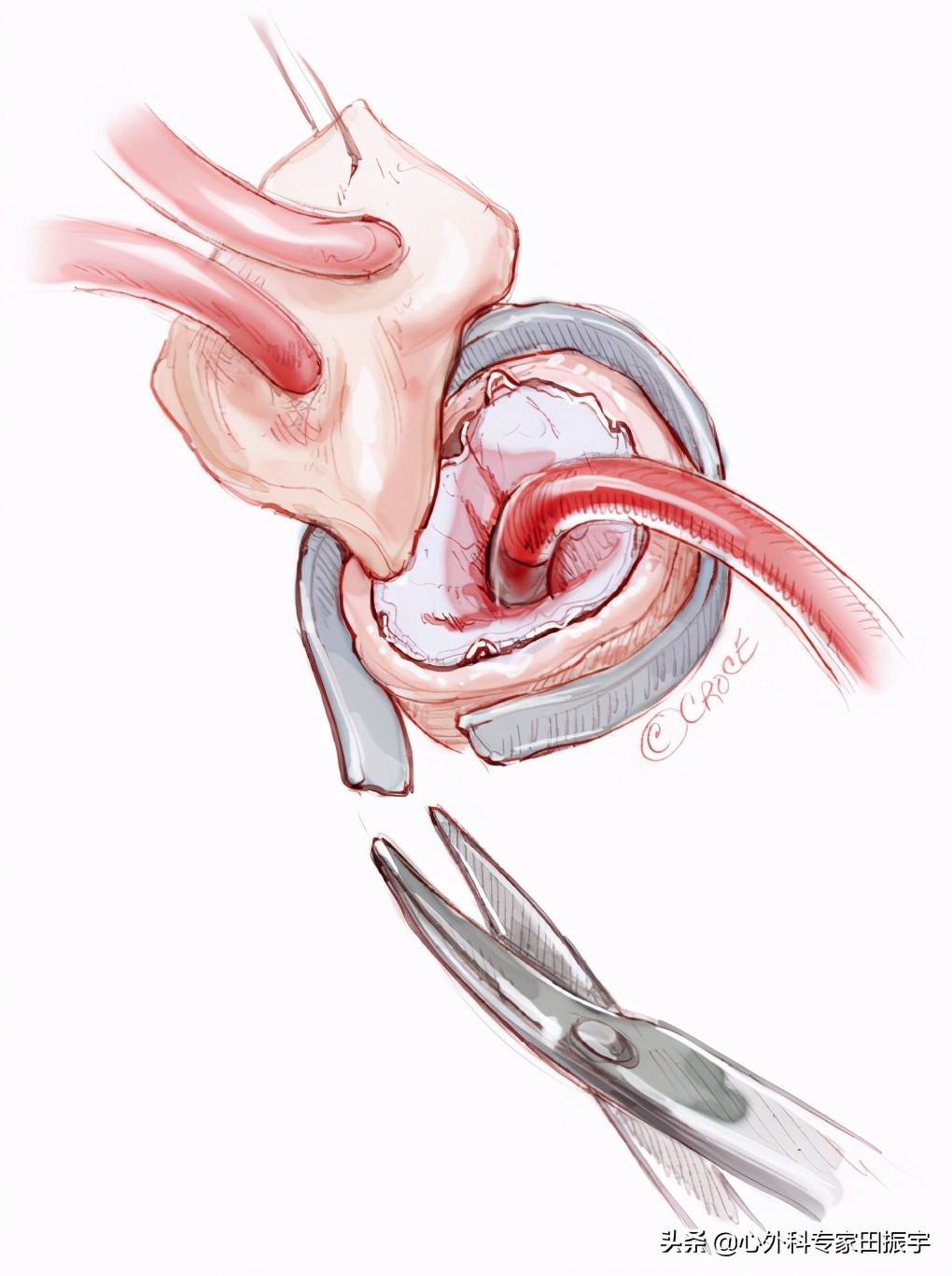 主动脉夹层破裂b型,急性主动脉夹层动脉瘤破裂