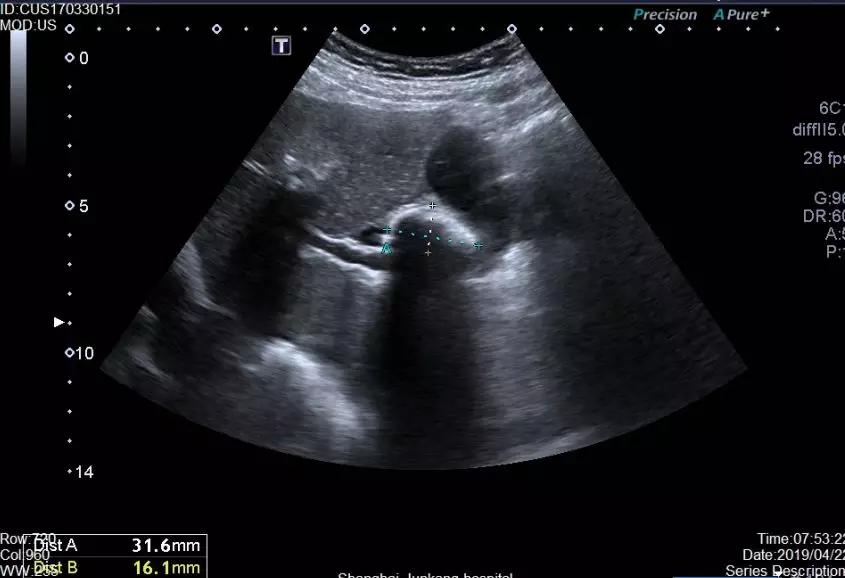 胆结石最佳治疗方法饮食注意什么,胆结石应注意些什么