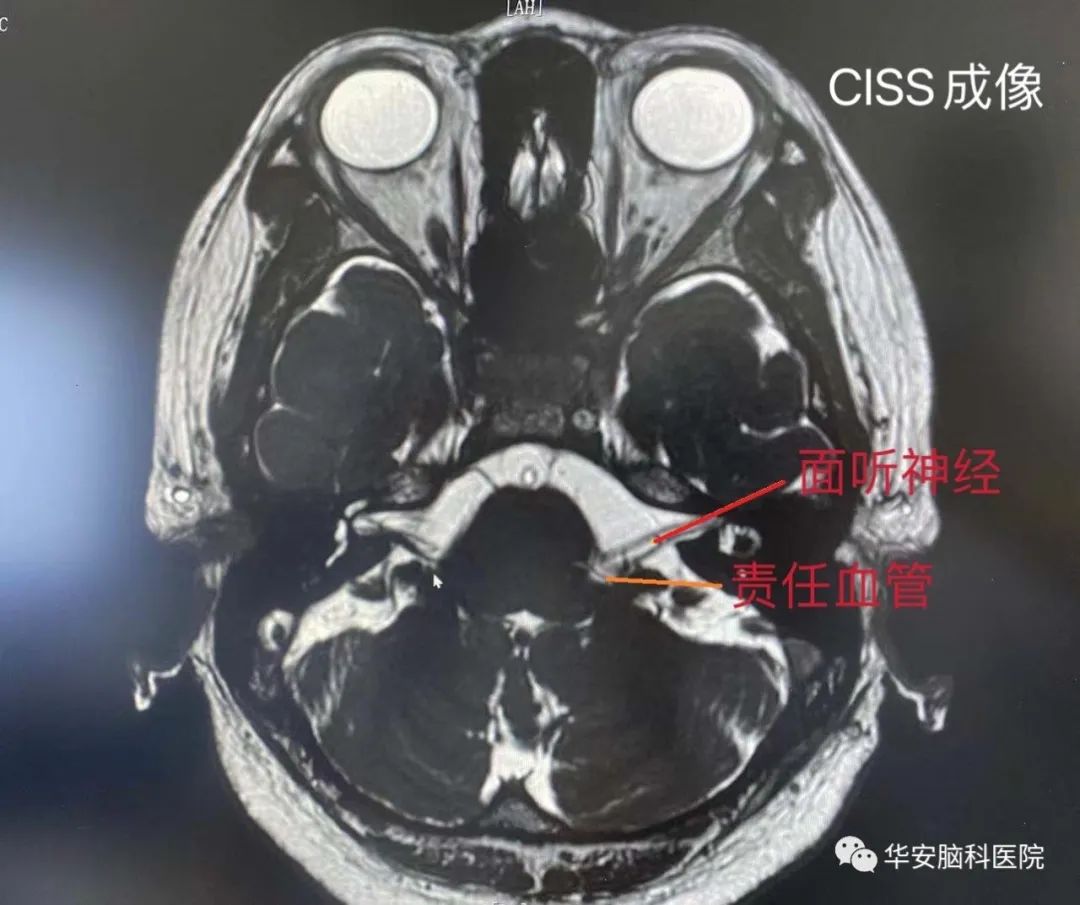 面神经显微血管减压手术,面肌痉挛显微减压术