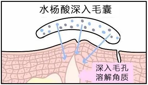 有多少人因为刷酸而烂脸,刷酸到底是换脸还是烂脸