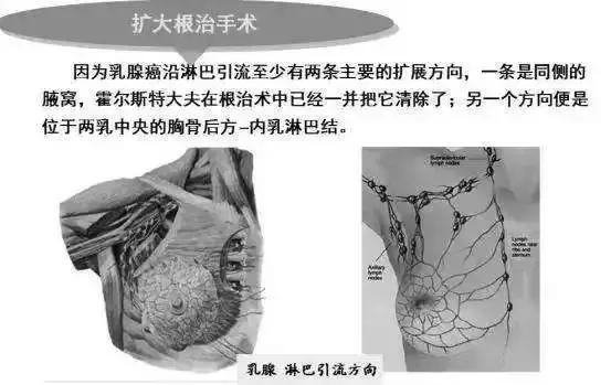 若有专家还在用这种方式治疗乳腺癌，不要犹豫，立马举报他