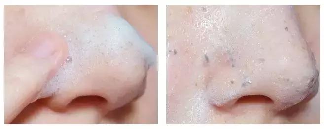 吸黑头神器去粉刺角质收缩毛孔,皮肤清洁收缩毛孔黑头角质