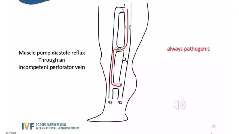 开幕第一天精彩回顾｜2020国际静脉病论坛持续进行中