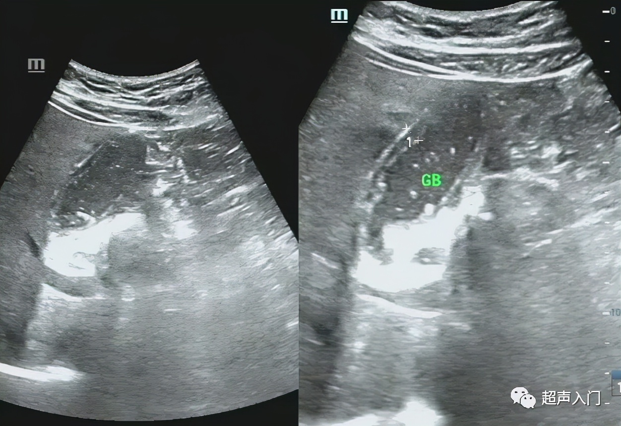 急性胆囊炎超声表现入门教学视频,急性胆囊炎超声诊断怎么写