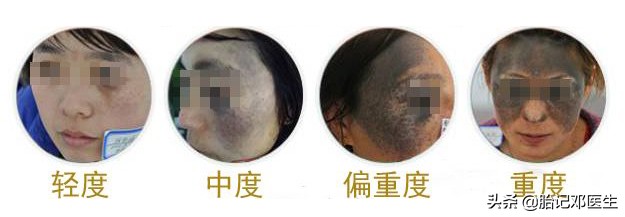 面容杀手,常见胎记的类型