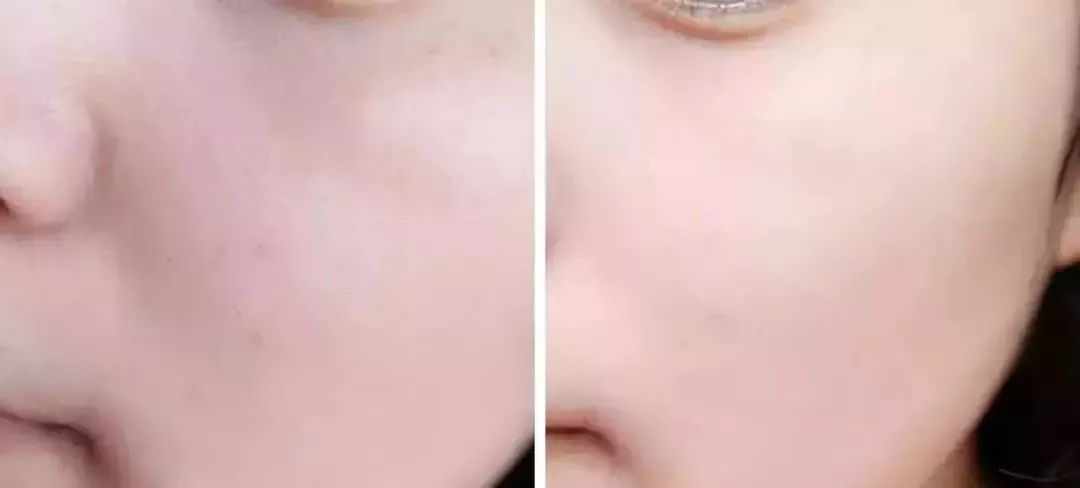 解决黑头的2种药,解决黑头的最好方法