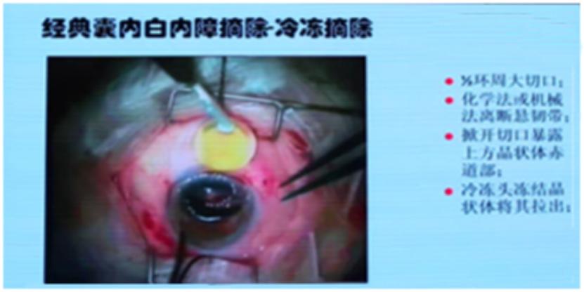 白内障手术技术历程,专家讲解白内障手术的重难点