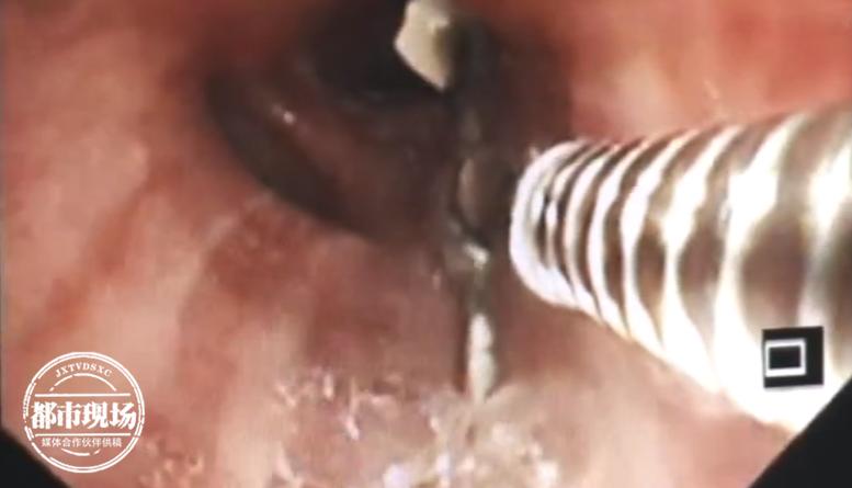 男子治牙结果4厘米针头掉进气管几天后他开始不停咳嗽