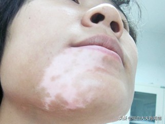 风油精=神药?55岁大姐迷恋风油精治白癜风,现已毁容了?