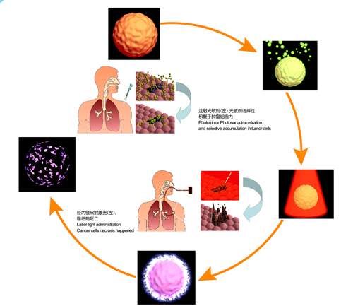 光动力肿瘤治疗进展,光动力治疗能完全去除肿瘤吗