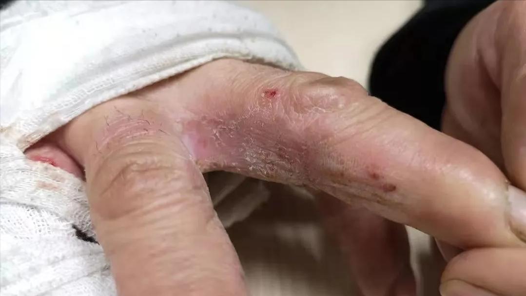 脚气会通过床单传染吗,脚气到底是怎么传染的