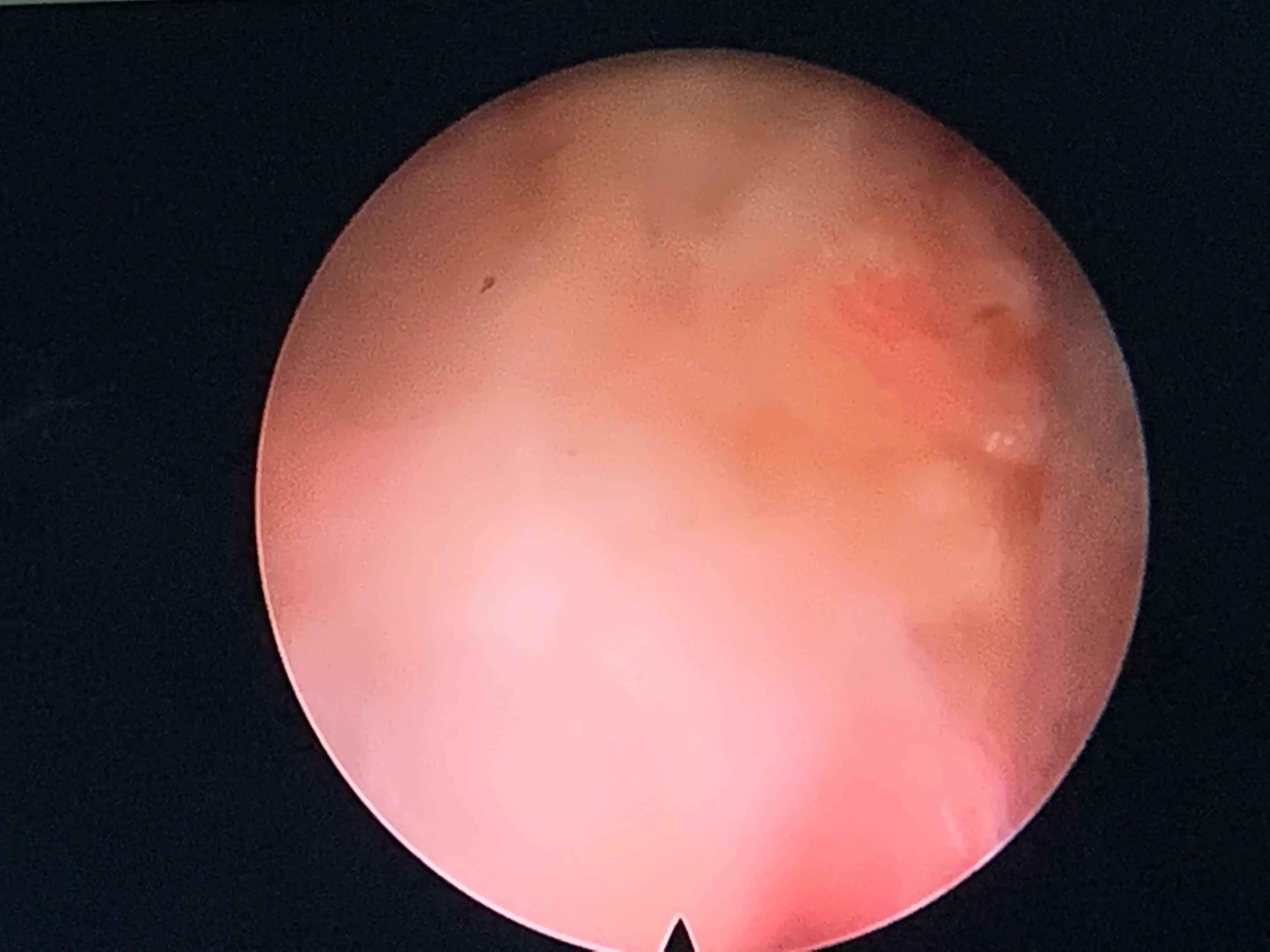 椎间孔镜术后腰痛症状多久消失,盘源性腰痛手术后易复发吗