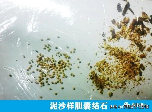 泥沙状胆囊结石2mm吃药可以排出么,有泥沙的胆囊结石能做保胆取石