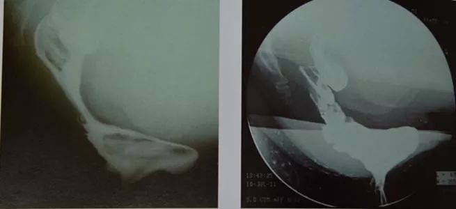 医学科普便秘篇之--直肠前突