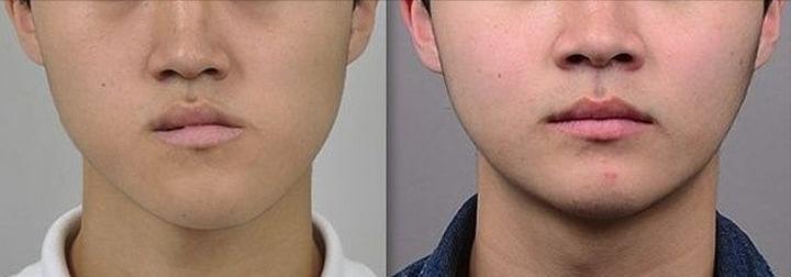 缺牙长期一侧咀嚼嘴巴倾斜,缺牙对咀嚼的影响