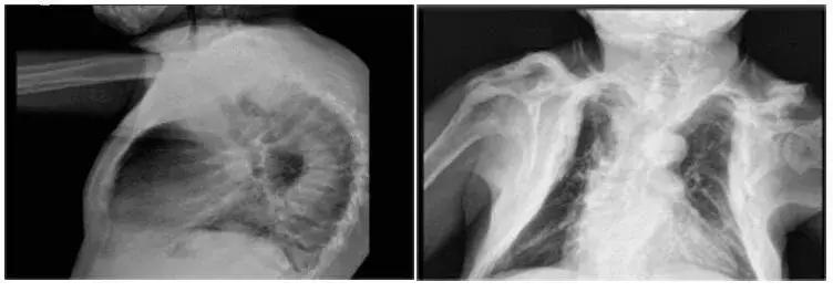 慢性肾病透析后肾还能恢复吗,慢性肾功能衰竭尿毒症透析