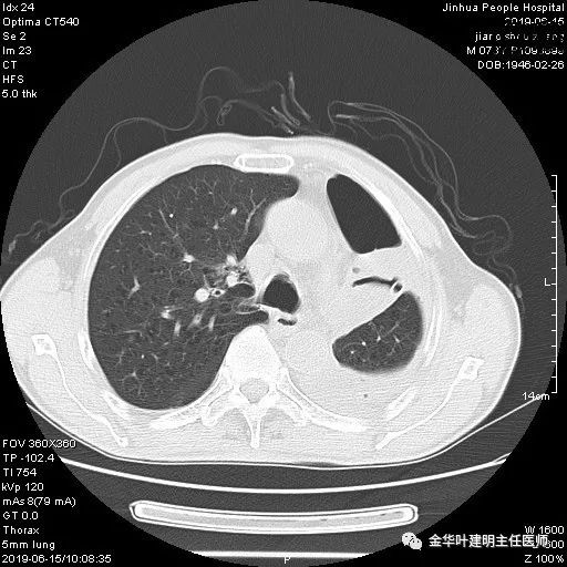 手术引起乳糜胸,有没有做了肺结节手术后是误诊的