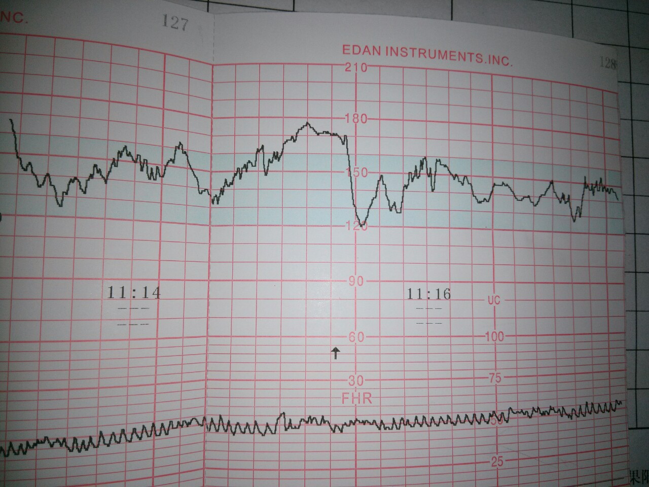 宫内缺氧的预兆,胎儿宫内慢性缺氧出生后如何补救