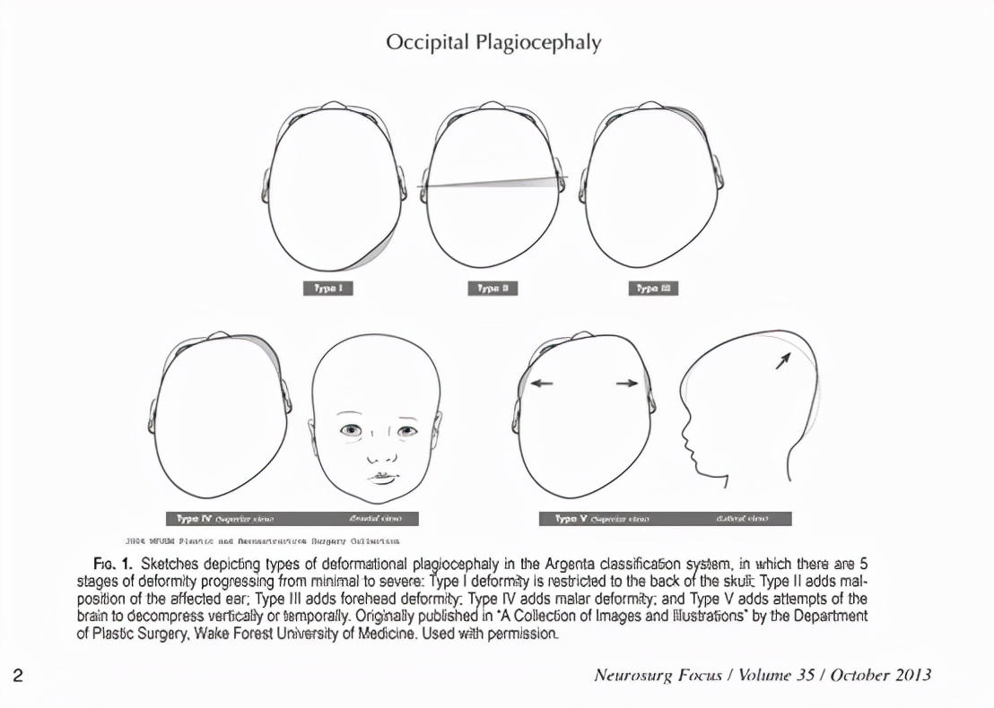 婴儿戴头盔矫正头型变畸形,婴儿戴摩托头盔