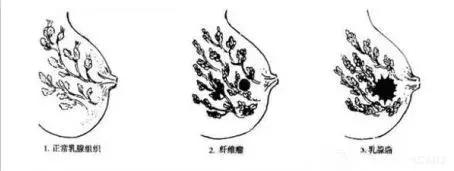 什么是乳腺纤维腺瘤？摸到乳房上有肿块，还不痛，就要小心了