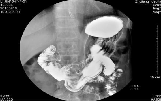 胃镜无法通过是什么原因,胃镜可以替代喉镜检查吗