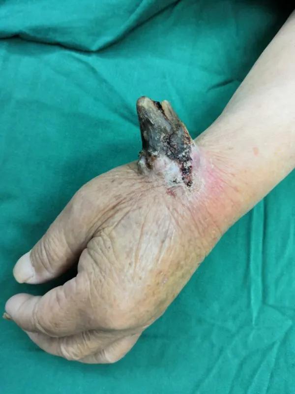 手上长个大犄角，怎么回事？