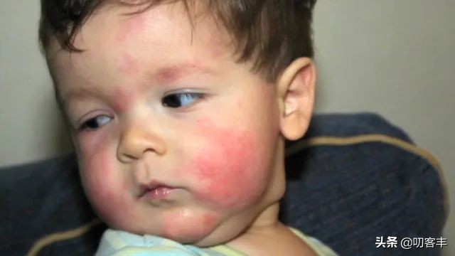 10个月宝宝食物过敏有哪些表现,婴幼儿易过敏的食物有哪些