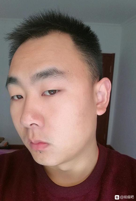 祛痘治疗后恢复,祛痘可以治好痘痘吗