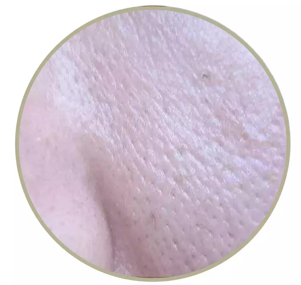 毛孔粗大后背长痘怎么办,女生后背毛孔粗大怎么办