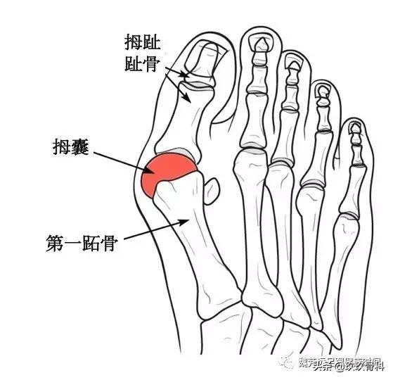 拇外翻大脚骨矫正工具正确用法,拇外翻和大脚骨有什么区别