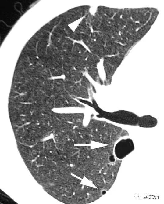 肺部感染并发症,老人新冠引起肺部并发症