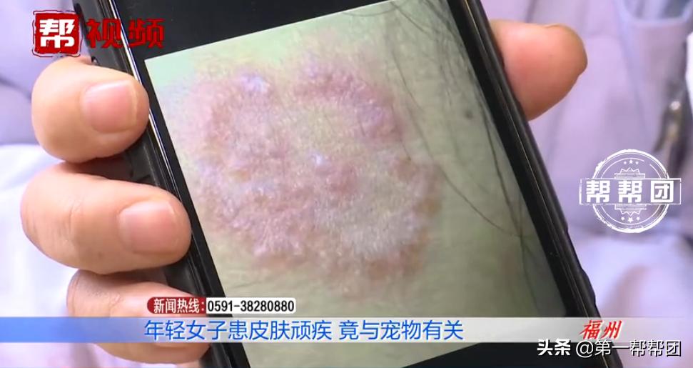 人传染上猫癣身上痒,七岁女孩染上猫癣