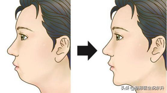 下巴假体好还是注射玻尿酸好,下巴是假体好还是玻尿酸好