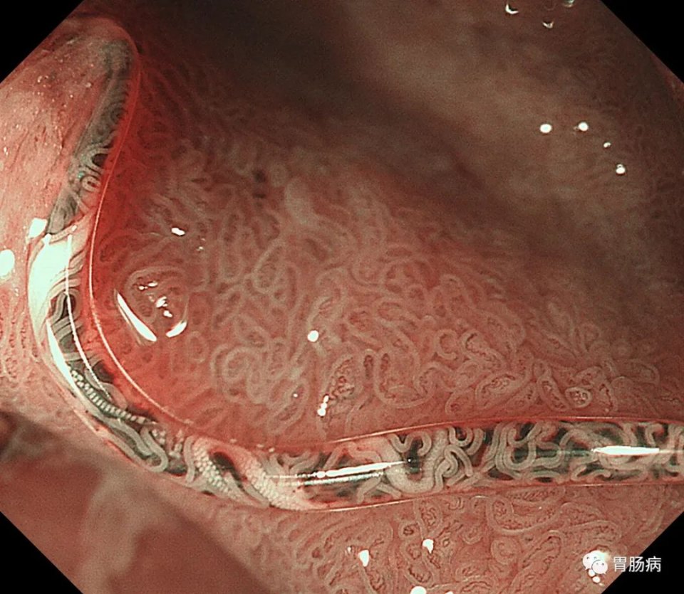 腹痛查不出病因全部检查都做了,腹痛查不出病因视频