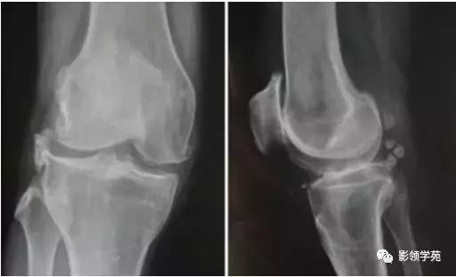 膝关节常见疼痛原因及其缓解方法,膝关节疼痛的16种最常见原因速查