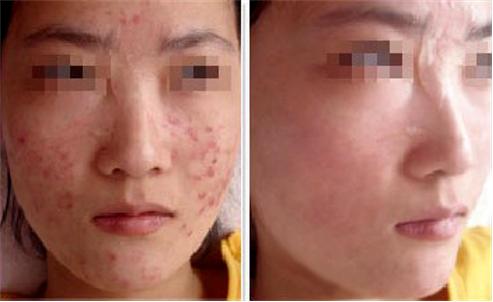 痘肌精华推荐祛痘印学生,油痘肌好用的祛痘精华推荐