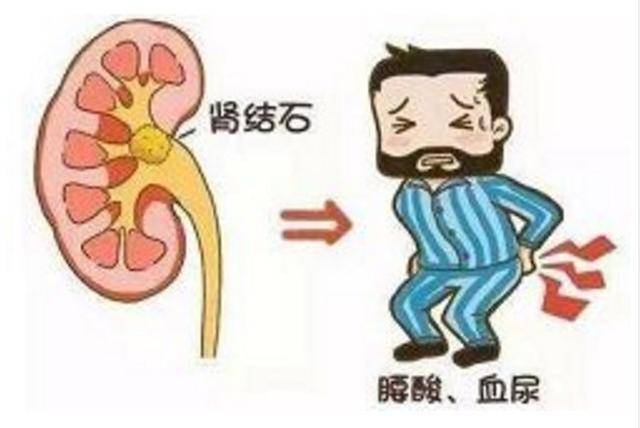 腰酸背痛会肾结石吗,腰酸是不是肾结石怎样治疗