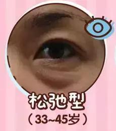 去眼袋15年后有细纹怎么办,祛眼袋之后会不会看着很平