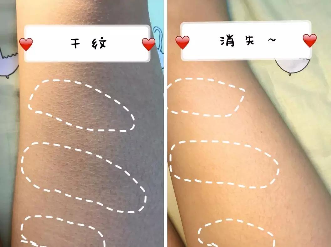 脚后跟老茧怎么去除,我的脚后跟有老茧变硬有细微开裂