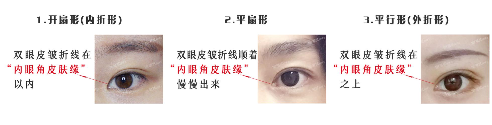 欧式大双眼皮和平行双眼皮,醒醒吧明智的放弃胜过盲目的执着