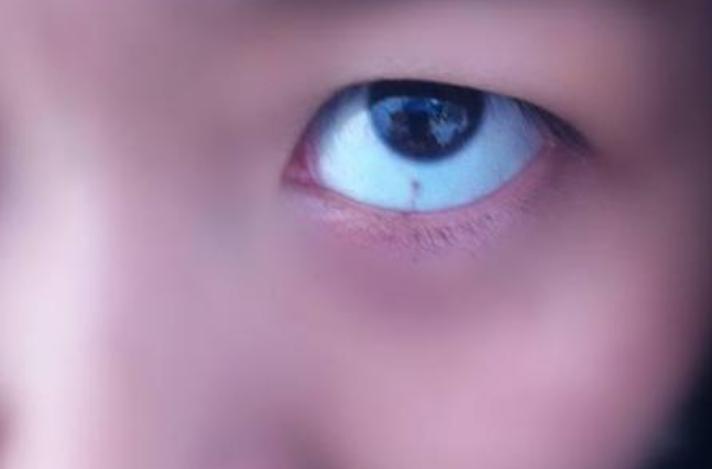 孩子眼白有小黑点是不好的表现吗,孩子眼白有青点是怎么回事